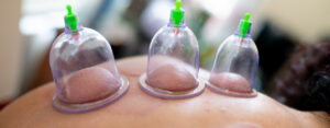 cupping therapy China Grove, Gastonia, Huntersville, Lincolnton, Locust, Mint Hill, Mount Holly, and Charlotte, NC